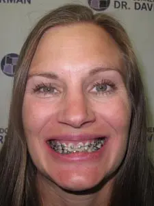 Four Corners Orthodontics & Dental - Before treatment