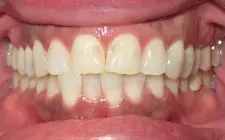 Four Corners Orthodontics & Dental - Before treatment