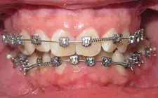 Four Corners Orthodontics & Dental - Before treatment