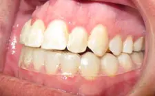 Four Corners Orthodontics & Dental - After Orthodontic Treatment