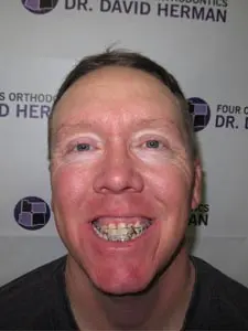 Four Corners Orthodontics & Dental - Before treatment