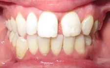 Four Corners Orthodontics & Dental - Before treatment