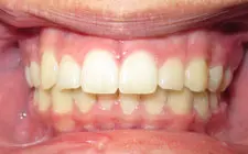 Four Corners Orthodontics & Dental - After treatment