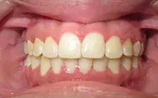 Four Corners Orthodontics & Dental - After treatment