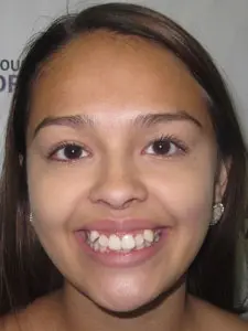 Four Corners Orthodontics & Dental - Before treatment