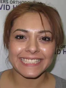 Four Corners Orthodontics & Dental - Before treatment