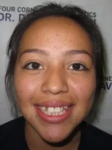 Four Corners Orthodontics & Dental - Before treatment