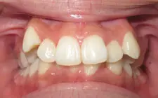Four Corners Orthodontics & Dental - Before treatment