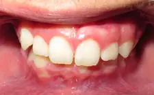 Four Corners Orthodontics & Dental - Before treatment