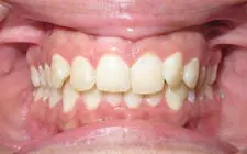 Four Corners Orthodontics & Dental - Before treatment