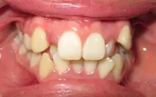 Four Corners Orthodontics & Dental - Before treatment