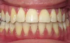Four Corners Orthodontics & Dental - After treatment