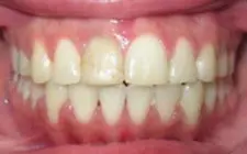 Four Corners Orthodontics & Dental - After treatment