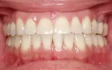Four Corners Orthodontics & Dental - After treatment