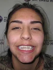 Four Corners Orthodontics & Dental - Before treatment