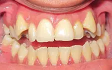 Four Corners Orthodontics & Dental - Before treatment