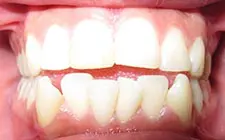 Four Corners Orthodontics & Dental - Before treatment