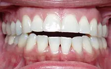Four Corners Orthodontics & Dental - Before treatment