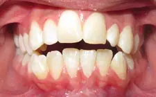 Four Corners Orthodontics & Dental - Before treatment
