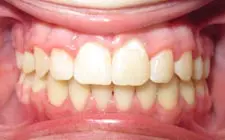 Four Corners Orthodontics & Dental - After treatment