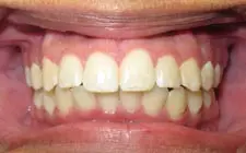 Four Corners Orthodontics & Dental - After treatment