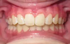 Four Corners Orthodontics & Dental - After treatment