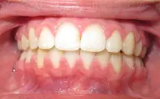 Four Corners Orthodontics & Dental - After treatment