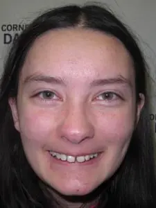 Four Corners Orthodontics & Dental - Before treatment