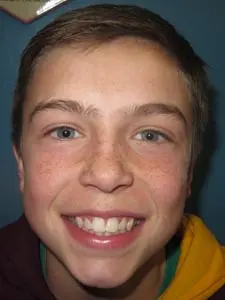 Four Corners Orthodontics & Dental - Before treatment