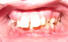 Four Corners Orthodontics & Dental - Before treatment