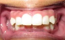 Four Corners Orthodontics & Dental - Before treatment