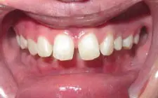 Four Corners Orthodontics & Dental - Before treatment
