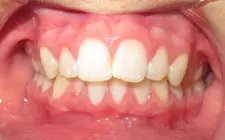 Four Corners Orthodontics & Dental - Before treatment