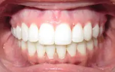 Four Corners Orthodontics & Dental - After treatment