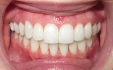 Four Corners Orthodontics & Dental - Before treatment