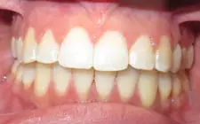 Four Corners Orthodontics & Dental - After treatment
