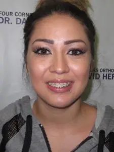 Four Corners Orthodontics & Dental - Before treatment