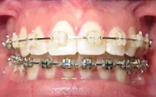Four Corners Orthodontics & Dental - Before treatment