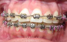 Four Corners Orthodontics & Dental - Before treatment