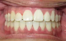 Four Corners Orthodontics & Dental - After treatment