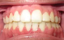 Four Corners Orthodontics & Dental - After treatment