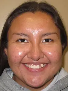 Four Corners Orthodontics & Dental - Before treatment