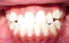 Four Corners Orthodontics & Dental - Before treatment