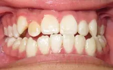 Four Corners Orthodontics & Dental - Before treatment