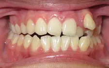 Four Corners Orthodontics & Dental - Before treatment