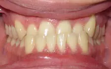 Four Corners Orthodontics & Dental - Before treatment