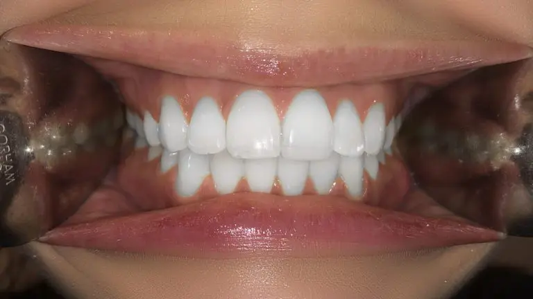 front smile