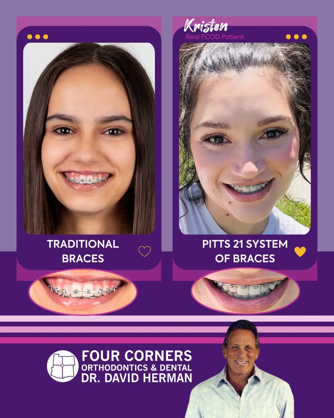 Traditional braces vs Pitts 21 System of braces