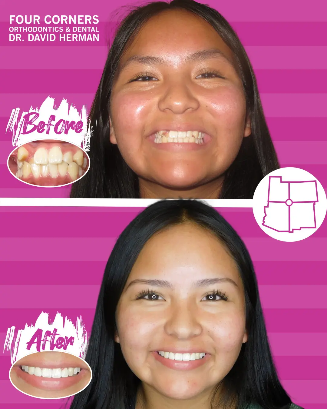 Split image with a smiling girl. Top shows her "Before" with uneven teeth; bottom shows her "After" with straight teeth. Background is pink-striped.