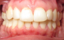Adelle A After-Teeth Retreatment